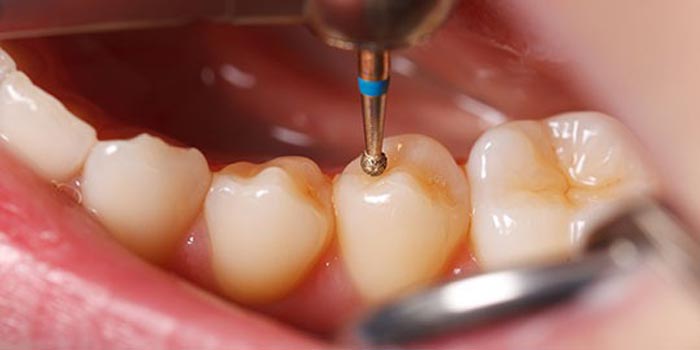 Image result for ‫ترمیم دندان‬‎