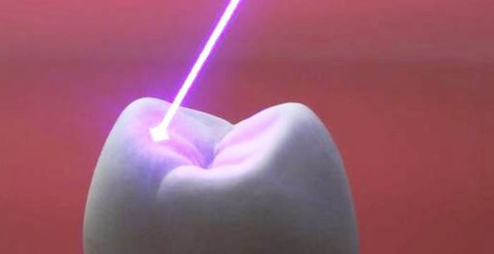 مزایای استفاده از دیود لیزرها در روت ‌کانال دندان
