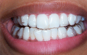 عملکرد ارتودنسی نامرئی