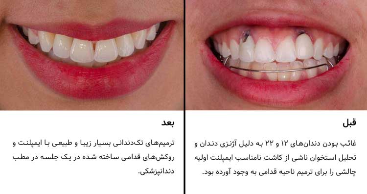 کاشت ایمپلنت آنکیلوز 