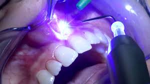 آیا دندانپزشکی با لیزر بی‌خطر است؟