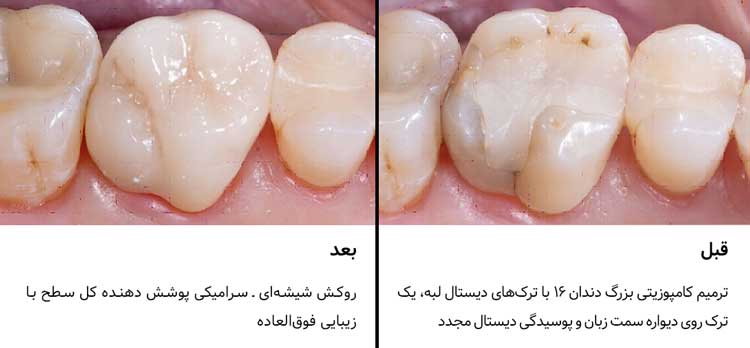 تک‌روکش IPS e.max CAD
