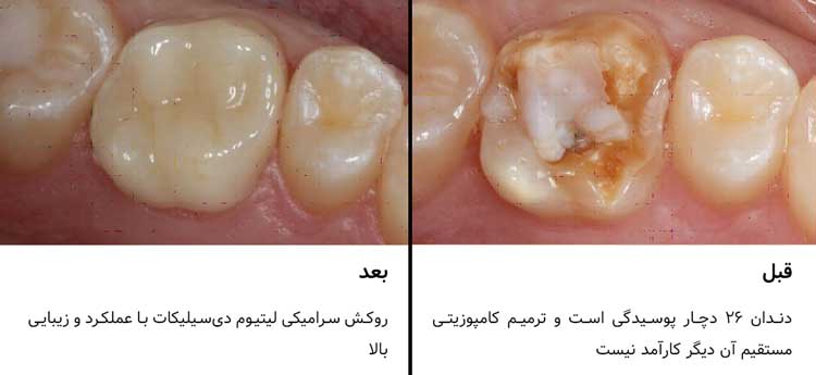 تک‌روکش IPS e.max CAD 