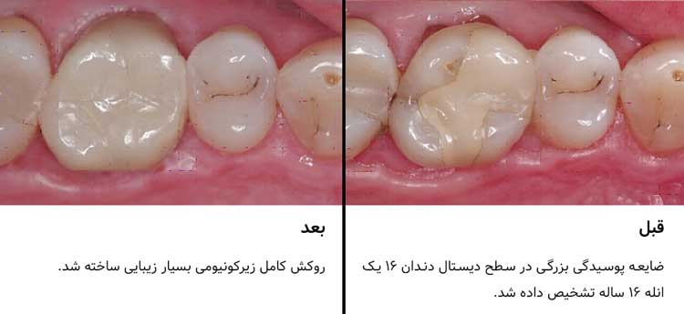 تک‌روکش زیرکونیومی سرک 