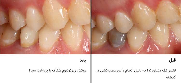تک‌روکش Katana Zirconia STML