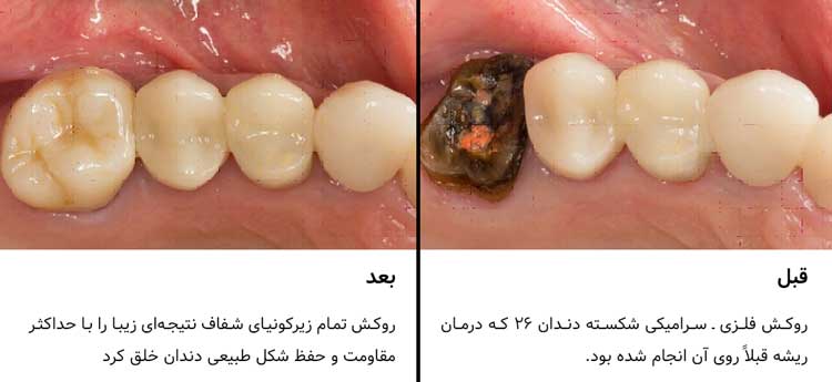 تک‌روکش Katana Zirconia STML ـ دندان