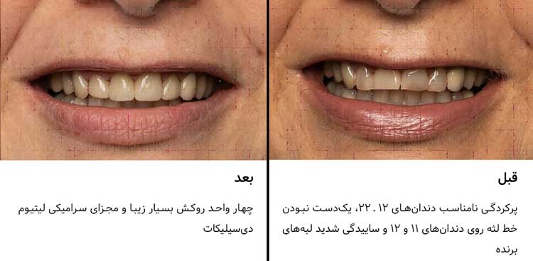 چهار واحد روکش مجزای IPS e.max CAD، دندان‌