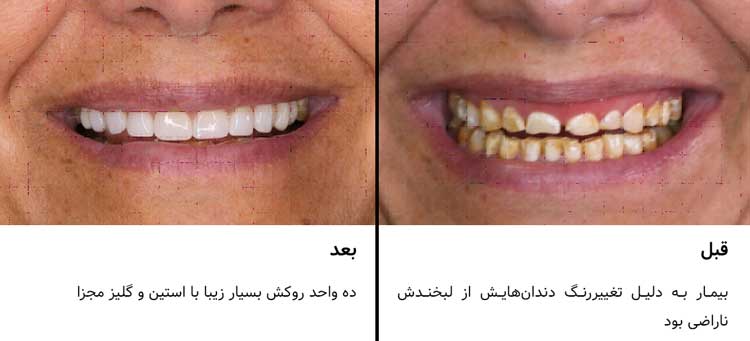 ده واحد روکش مجزای VITA Suprinity PC ـ دندان‌