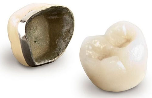 روکش پرسلین