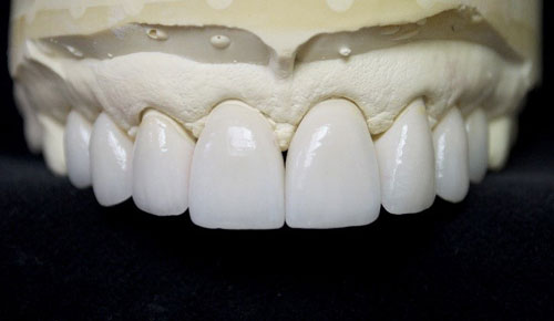 روکش زیرکونیوم