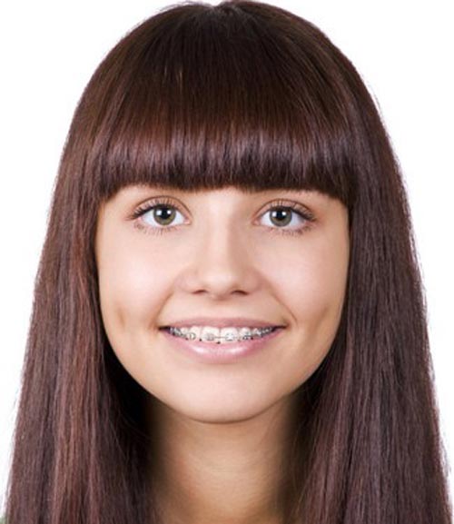 سیم کشی دندان چقدر طول میکشد