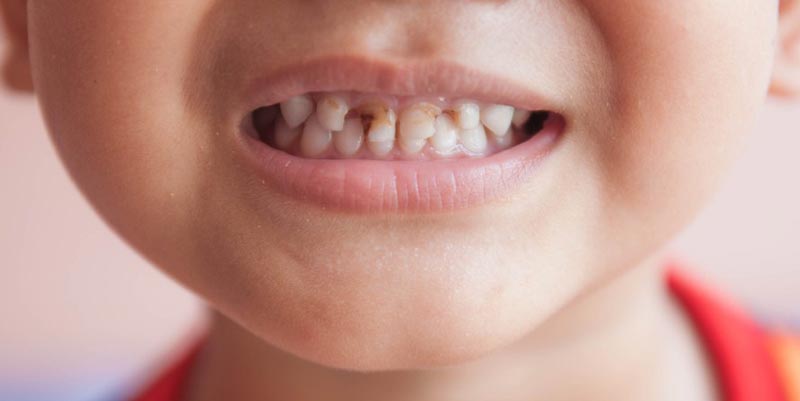 درمان پوسیدگی و خرابی دندان