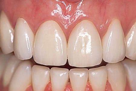 پرکردن دندان با گلاس آینومر