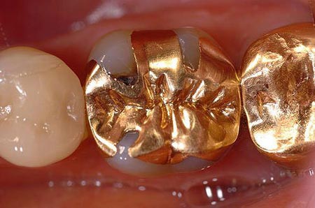 پرکردن دندان با طلا