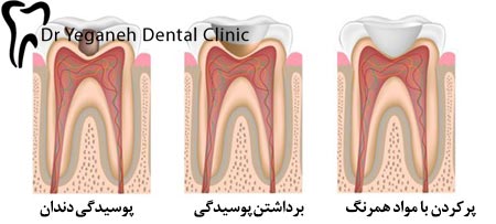 پرکردن دندان چقدر زمان میبرد