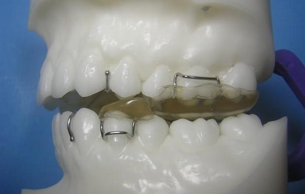 ابزار ارتودنسی تویین بلاک