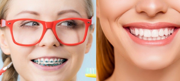 ارتودنسی بهتر است یا لمینت دندان مقایسه بریس و ونیر دندان