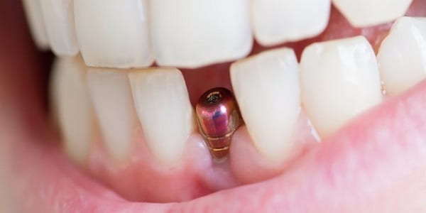 ایمپلنت برای درمان فاصله بین دندان‌ها