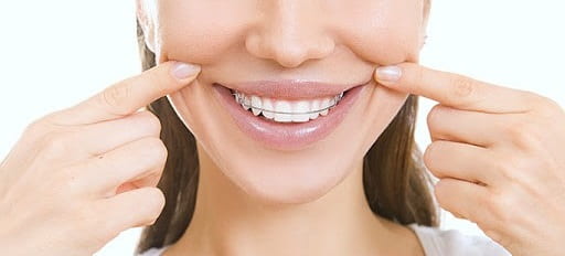 بریس چگونه بر بهداشت دهان و دندان تأثیر می‌گذارد؟