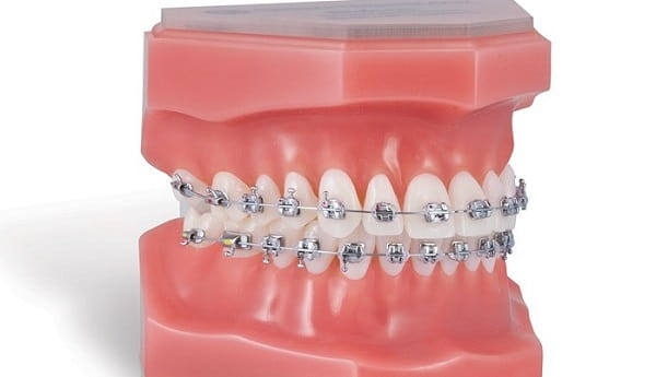 بریس‌های ارتودنسی ثابت