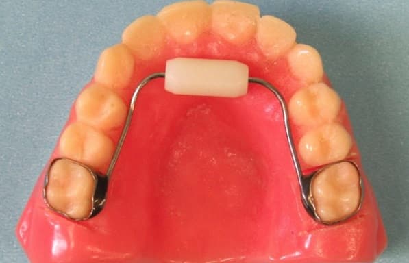 دستگاه برطرف کننده عادت ارتودنسی ثابت