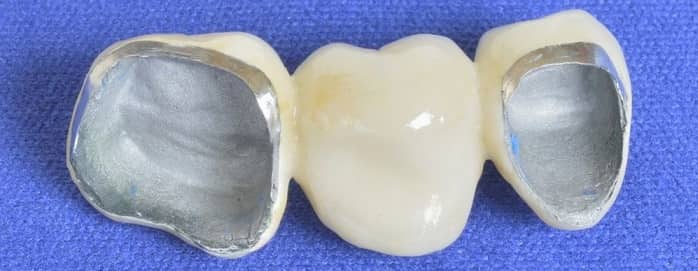 روکش پرسلن به فلز برای دندان