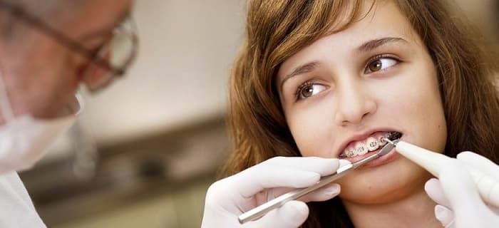 لق شدن دندان در ارتودنسب بر اثر فشار ارتودنسی