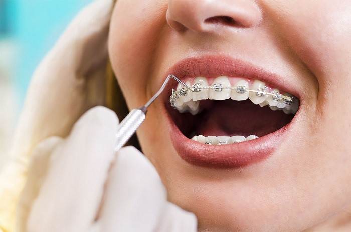 مرتب و صاف کردن دندان با ارتودنسی