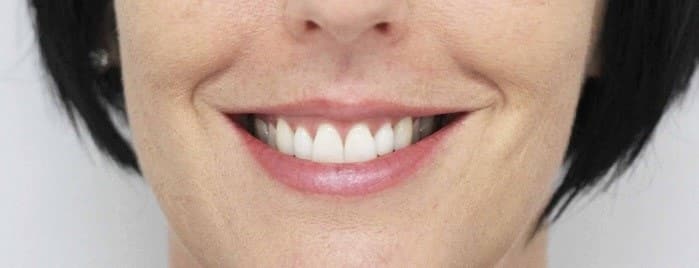 نتایج لیفت لثه و افزایش طول تاج دندان