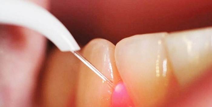 نتیجه بهتر استفاده از لیزر در روت‌ کانال