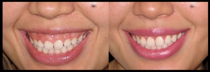 کاندیدا مناسب لیفت لثه و افزایش طول تاج دندان