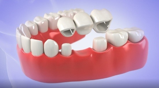 کاربرد بریج دندان
